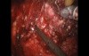 Robotic Prostatectomy in Prostate Cancer Patient - Nerve Sparing