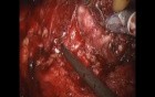Robotic Prostatectomy in Prostate Cancer Patient - Nerve Sparing