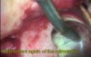 Microsurgery in Endodontics - surgical video