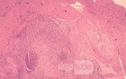 Gastrointestinal Stromal tumor (GIST) (59 of 65)