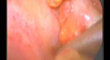Laparoscopic Appendectomy