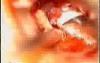 Tympanoplasty With Audio Commentary
