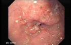 Adenocarcinoma of the middle third (1 of 5 )