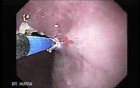 Barrett's Esophagus of long segment (6 of 11)