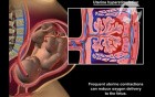 Interruption of Maternal-Fetal Oxygen Delivery