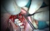 Regeneration Of Multialveolar Process 16-17 (2/4