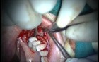 Regeneration Of Multialveolar Process 16-17 (2/4