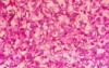 Metastasis of Renal Carcinoma to the ascending colon (9 of 11)