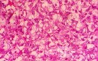 Metastasis of Renal Carcinoma to the ascending colon (9 of 11)