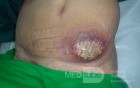 Carbuncle - Anterior Abdominal Wall 