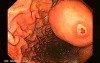 Endoscopy of gastric leiomyoma