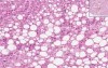 Liver - Fatty Change 2