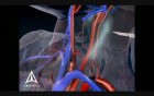 Carotid Endarectomy - 3D Medical Animation