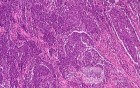 Adenocarcinoma of the Antrum and incisura angularis (11 of 12)