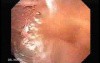 Brunner's Gland Adenoma (1 of 2)