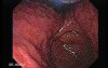 Esophagus - Pneumatic Dilation for Achalasia - Video from the Procedure