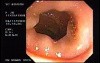 Adenocarcinoma Of The Transverse Colon - Endoscopy (9 of 9)