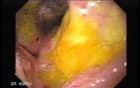 Gastroduodenal MALT lymphoma (6 of 9)