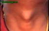 Thyroglossal Cyst