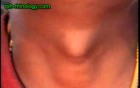 Thyroglossal Cyst