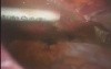Laparoscopic Ventral hernioplasty