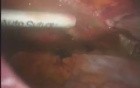 Laparoscopic Ventral hernioplasty