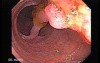 Colonoscopic Polypectomy (4 of 29)