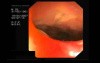 Rectal Perforation