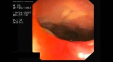 Rectal Perforation