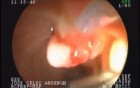 Duodenal papilla adenoma- EUS resection