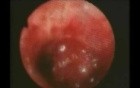 Bronchoscopic Resection Of Carcinoid tumor