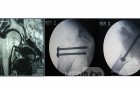 Stress fracture of Rt. femoral neck