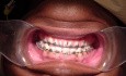 Orthodontic Case #4 - One Method To Retract Anterior Maxillary Segment W/ Surgical Hooks And Coil
