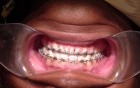 Orthodontic Case #4 - One Method To Retract Anterior Maxillary Segment W/ Surgical Hooks And Coil