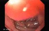 Duodenal Ulcer (2 of 5)