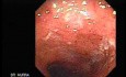 Endoscopy Of Ulcerative Colitis (1 of 3)