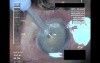 Cataract Surgery 3 - Part 1
