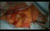 Open Right Hemicolectomy – Technical Principles - Operation No 1 - Part 1