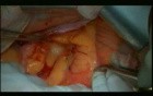 Open Right Hemicolectomy – Technical Principles - Operation No 1 - Part 1