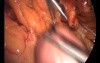 Laparoscopic Conversion of VBG to CRnYGB Including Technical Problems and Complication Management