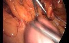 Laparoscopic Conversion of VBG to CRnYGB Including Technical Problems and Complication Management