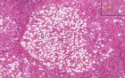 Alcoholic liver disease - Histopathology - Liver