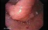 Candidiasis - Lesions in the Oropharynx
