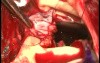 The Technique of Aortic Root Replacement - a Treatment for Endocarditis