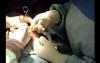 Breast augmentation surgery