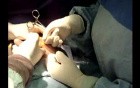 Breast augmentation surgery