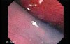 Colonoscopic Polypectomy (5 of 23)
