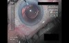 Cataract Surgery XII - Part 5