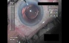 Cataract Surgery XII - Part 5