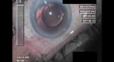 Cataract Surgery XII - Part 5